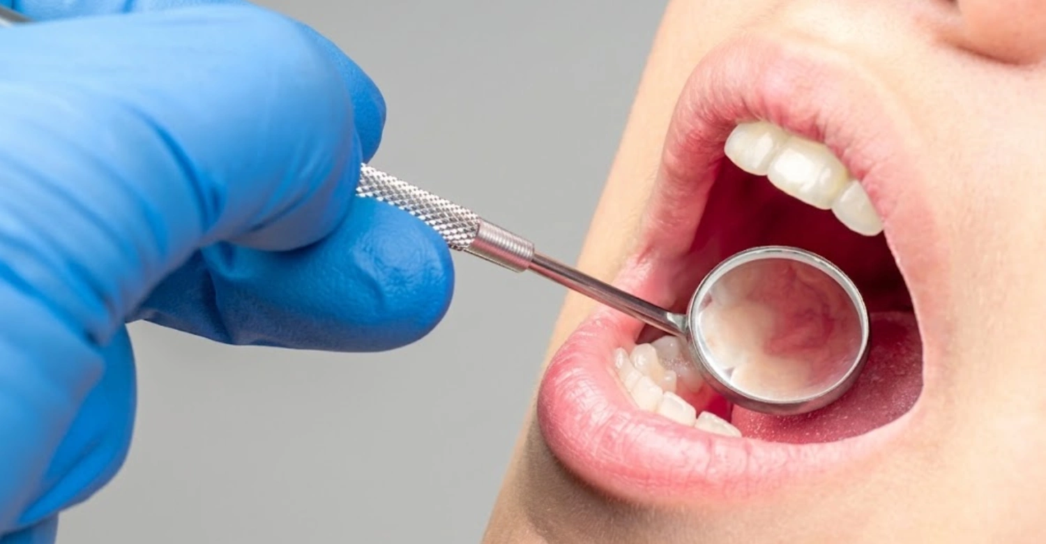 Inflammatory lesions of oral cavity INBLOG